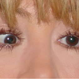 Young woman with Adult Strabismus.