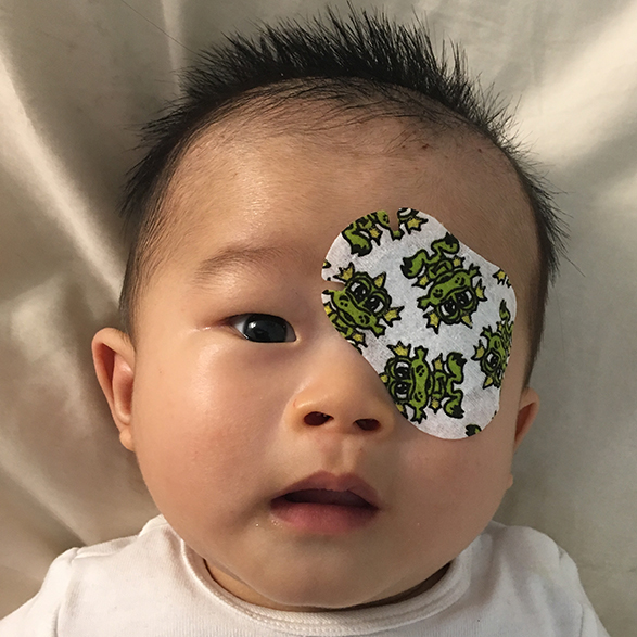 Young child being treated for amblyopia.
