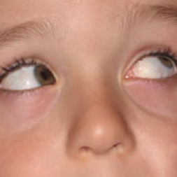 Child with Brown Syndrome.