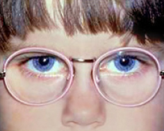 Four-year old girl treated for accommodative esotropia.