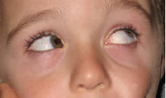 This child has a Brown's syndrome of the right eye.