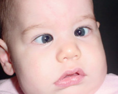 Young child with esotropia.
