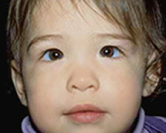 Child with pseudoesotropia