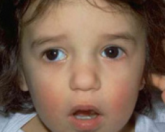 Three-year old girl with an intermittent exotropia.