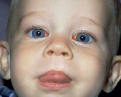 Photograph of child in recovery room following strabismus surgery