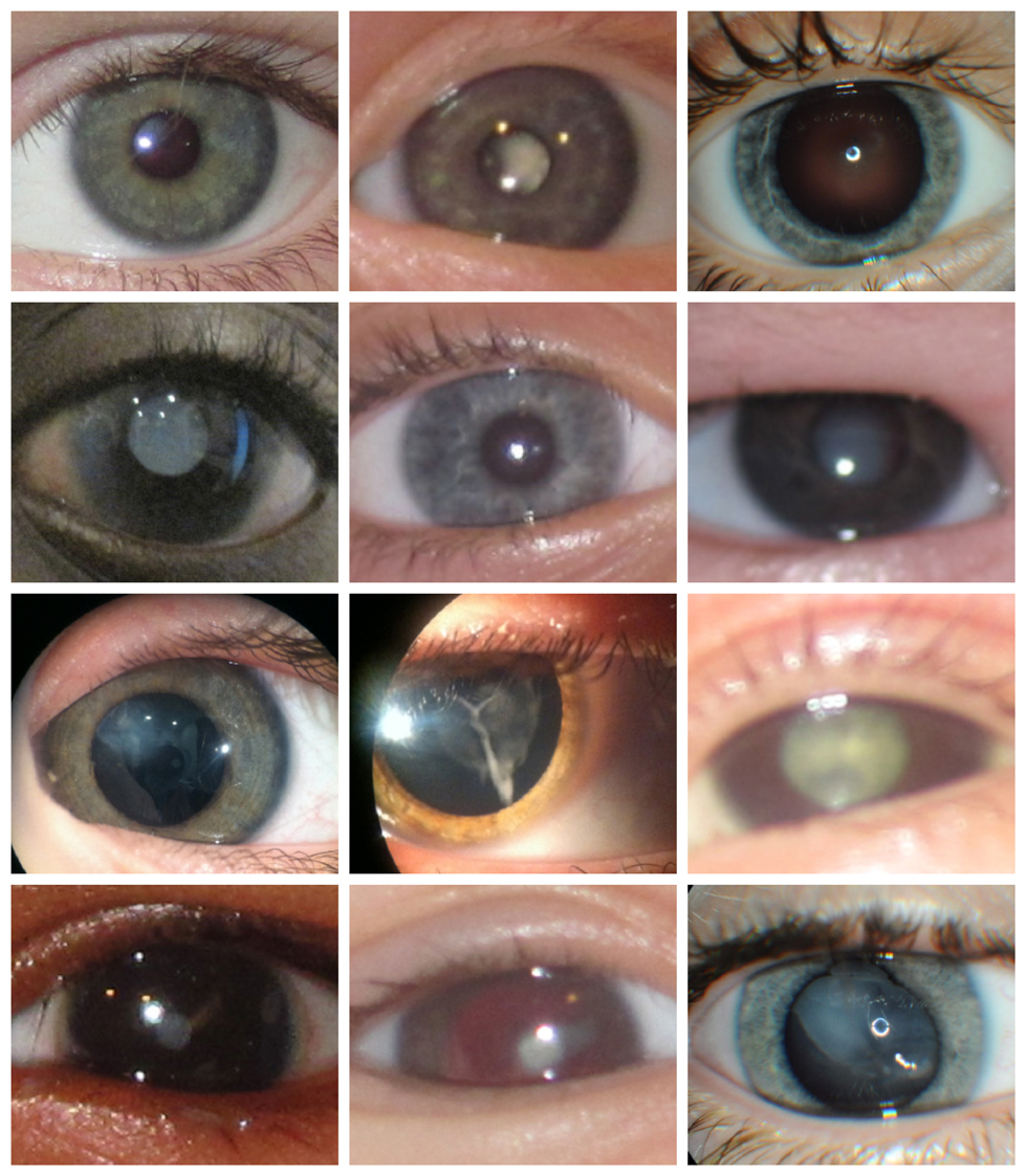 Some examples of pediatric cataracts that we operated recently.