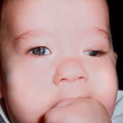Baby exhibiting Complex Strabismus & Syndromes.