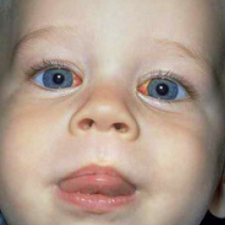 Child after eye muscle surgery.