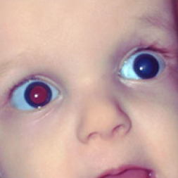 Child with Pediatric Cataracts