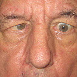 Adult male with sixth nerve palsy.