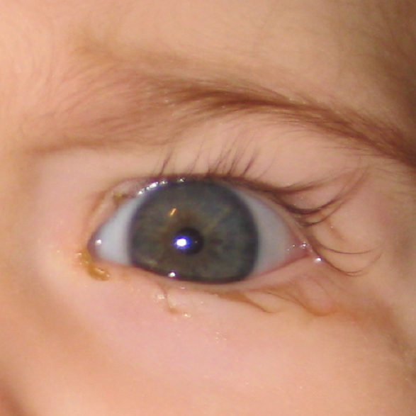 Child with Tear Duct Obstruction