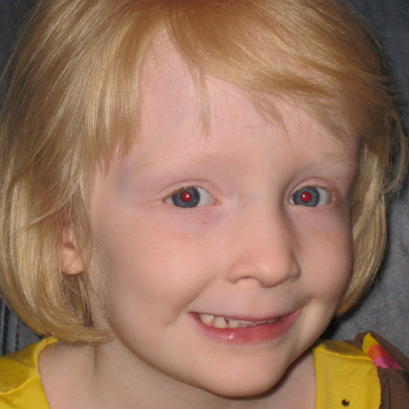 Child before Nystagmus Surgery.