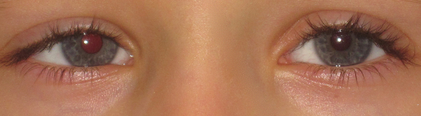 Before- Accommodative Esotropia