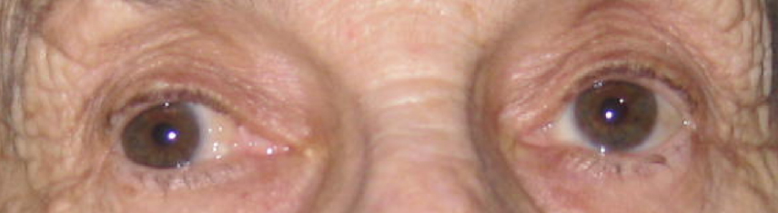 Before-Adult Strabismus