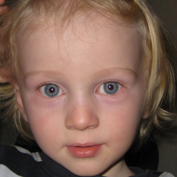 After-Nystagmus