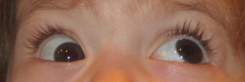 child’s right eye is not able to elevate when looking toward left.
